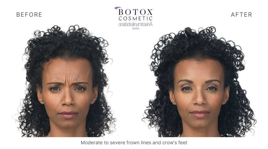 Botox Ormond Beach FL 3 Total Anti-Aging and Wellness