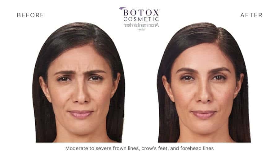 Botox Ormond Beach FL 4 Total Anti-Aging and Wellness