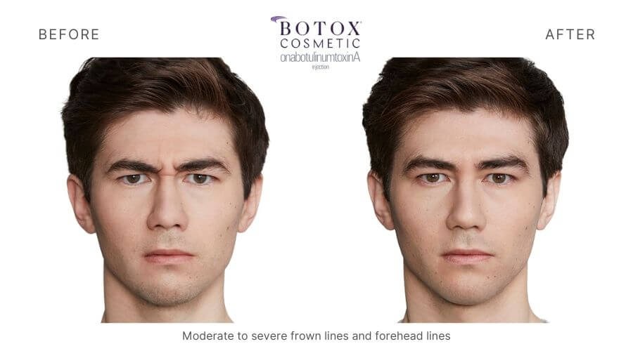 Botox Ormond Beach FL 5 Total Anti-Aging and Wellness