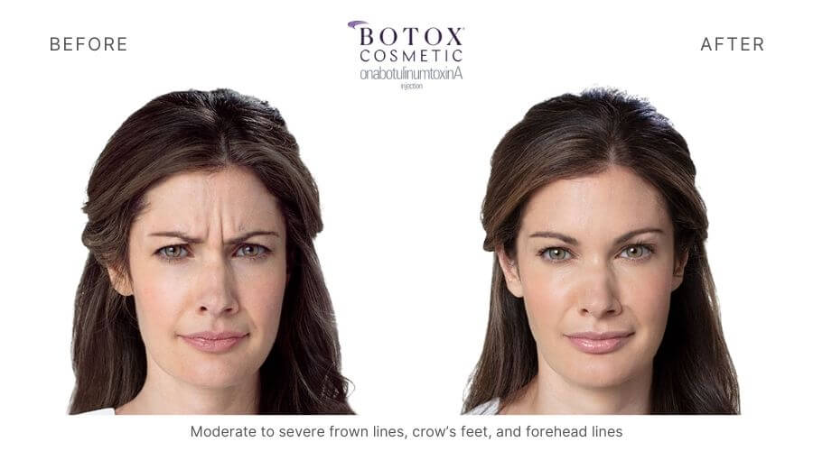 Botox Ormond Beach FL 6 Total Anti-Aging and Wellness