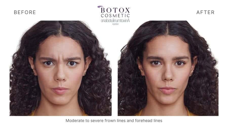 Botox Ormond Beach FL 7 Total Anti-Aging and Wellness