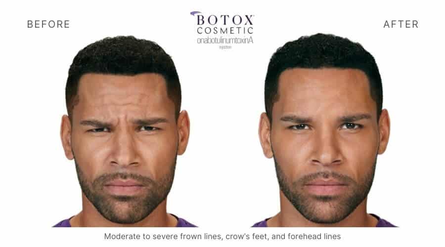 Botox Ormond Beach FL 8 Total Anti-Aging and Wellness