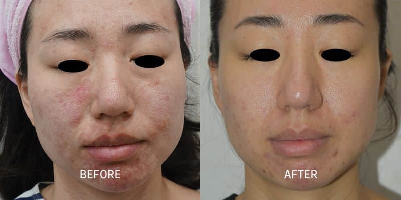 Potenza RF Microneedling 3 Total Anti-Aging and Wellness