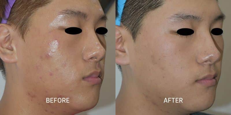 Potenza RF Microneedling 4 Total Anti-Aging and Wellness