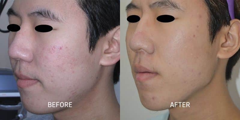 Potenza RF Microneedling 6 Total Anti-Aging and Wellness