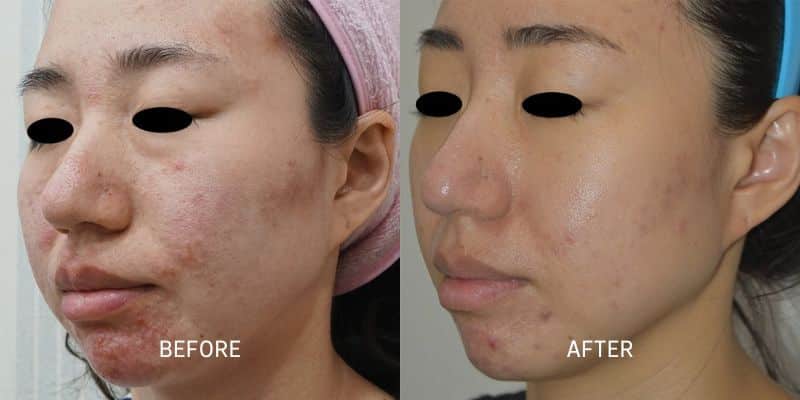 Potenza RF Microneedling 7 Total Anti-Aging and Wellness