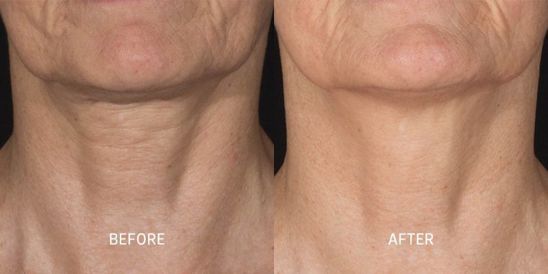 Potenza RF Microneedling 8 Total Anti-Aging and Wellness