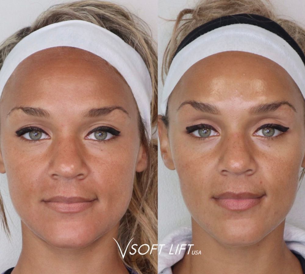 Botox Holly Hill FL