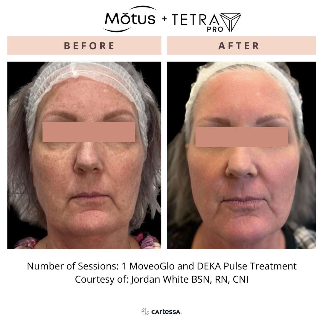 CoolPeel Laser Treatment 6 Total Anti-Aging and Wellness