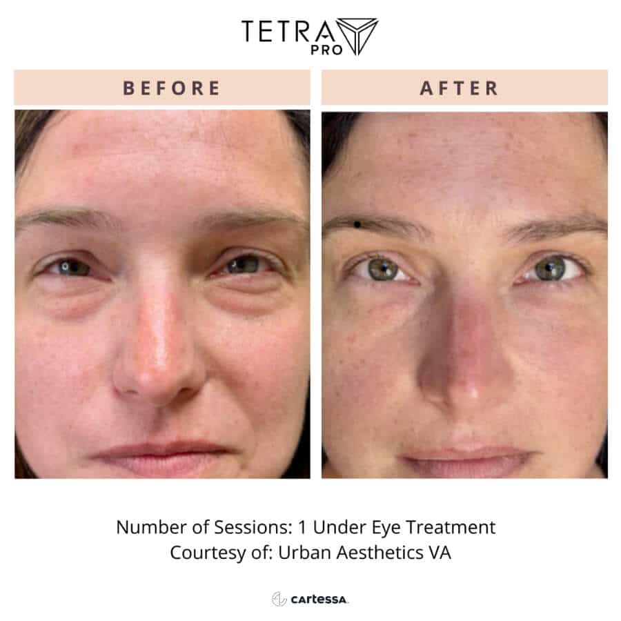 CoolPeel Laser Treatment 4 cool peel face
