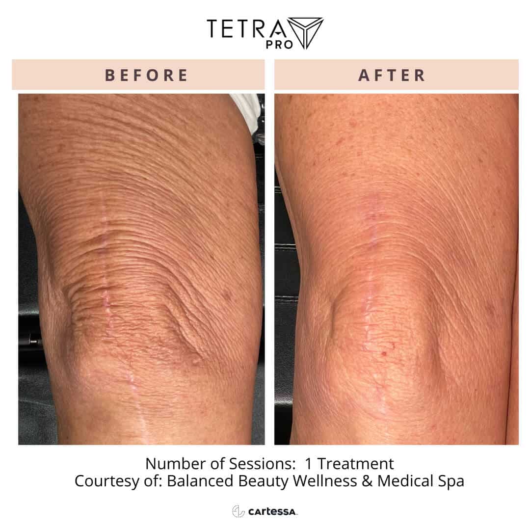 CoolPeel Laser Treatment 5 cool peel knees