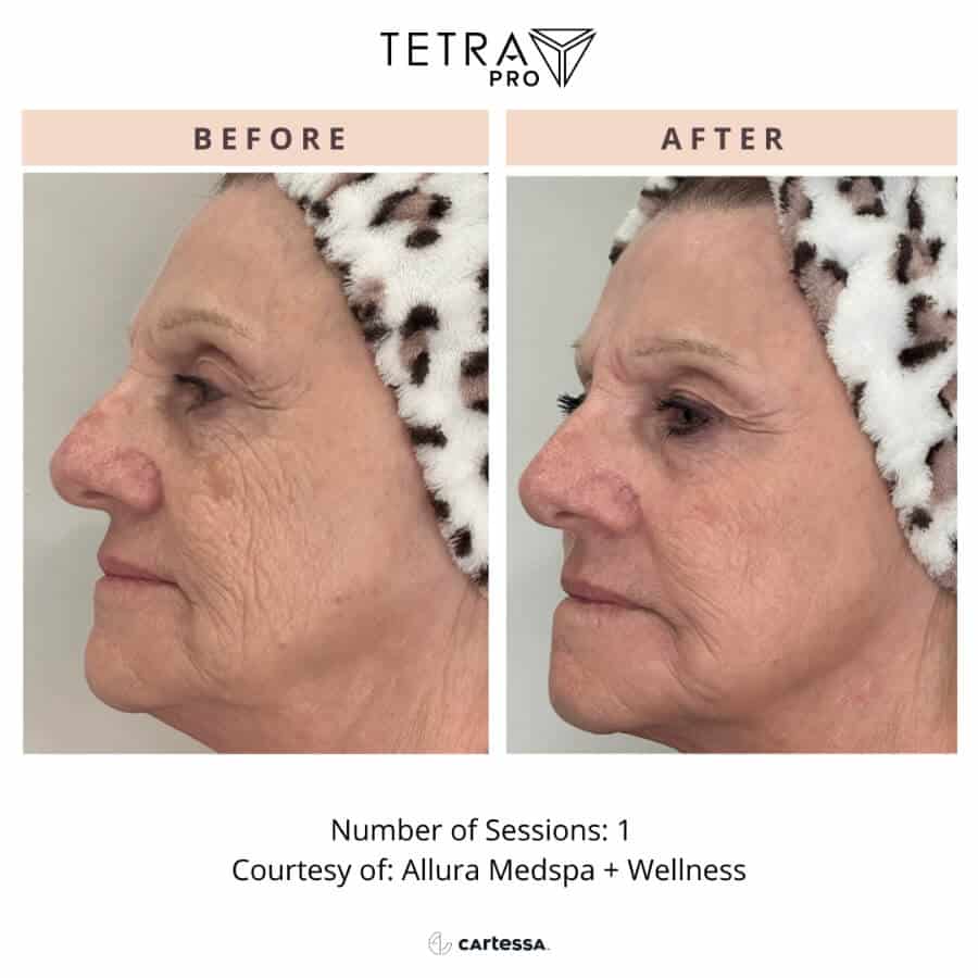 CoolPeel Laser Treatment 7 cool peel