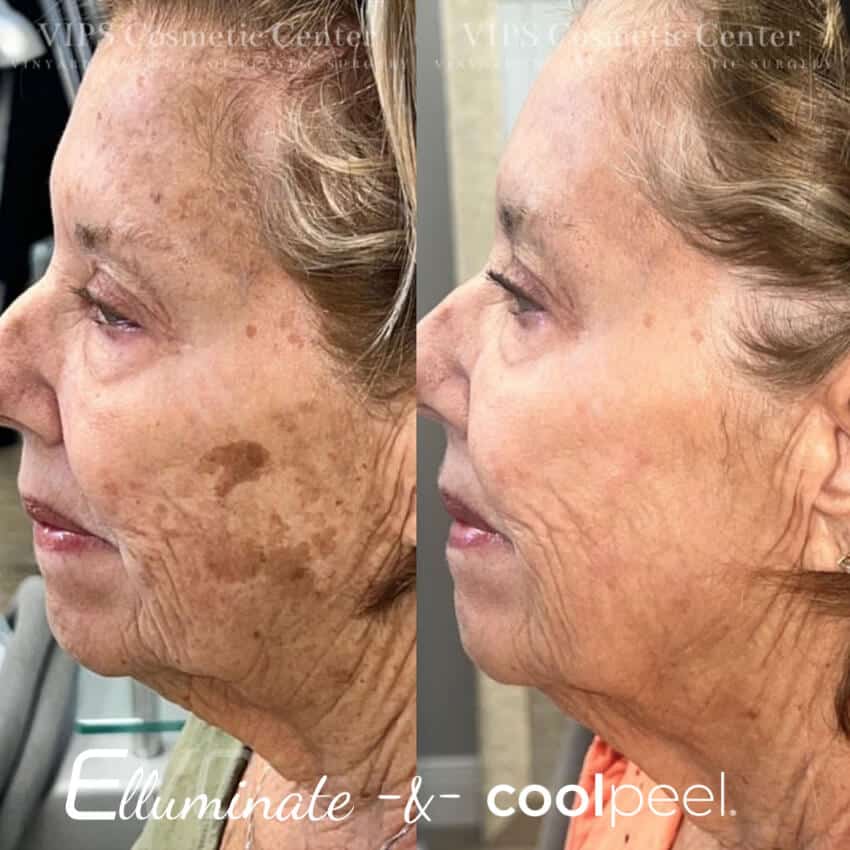 cool peel before and after