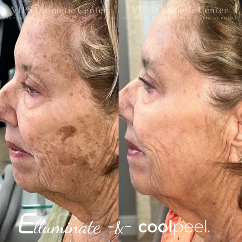 CoolPeel Skin Tone